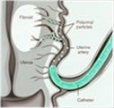 Fibroid treatment graphic