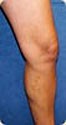 After Varicose