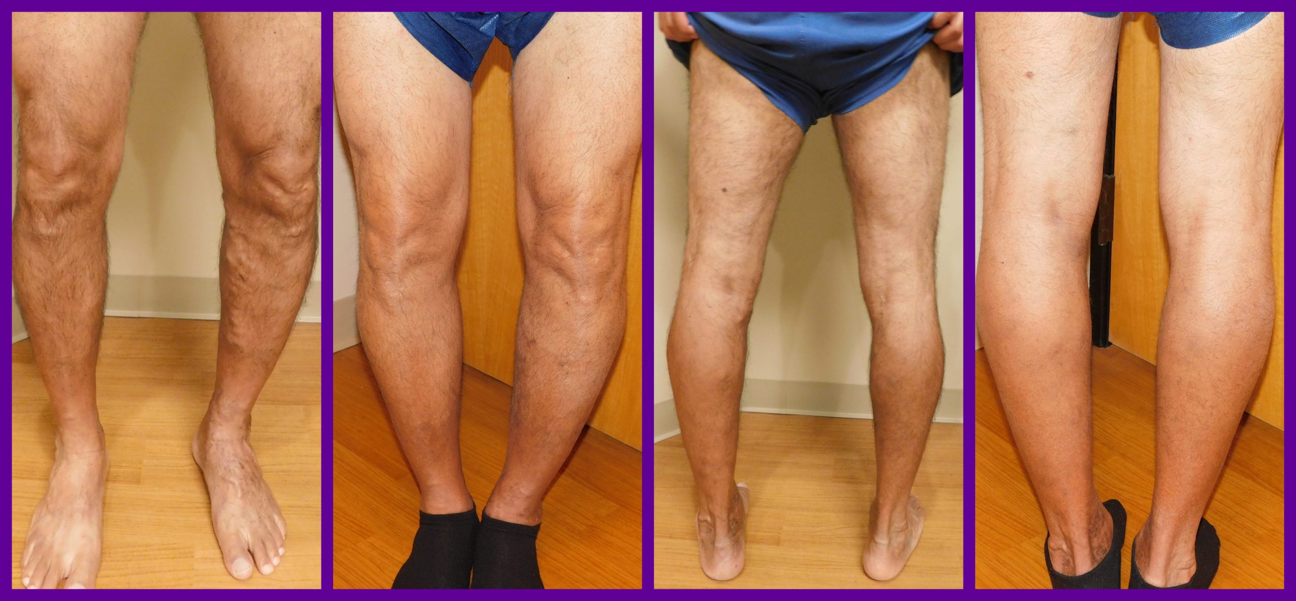 Varicose Vein Treatment, Vanishing Veins Northwest