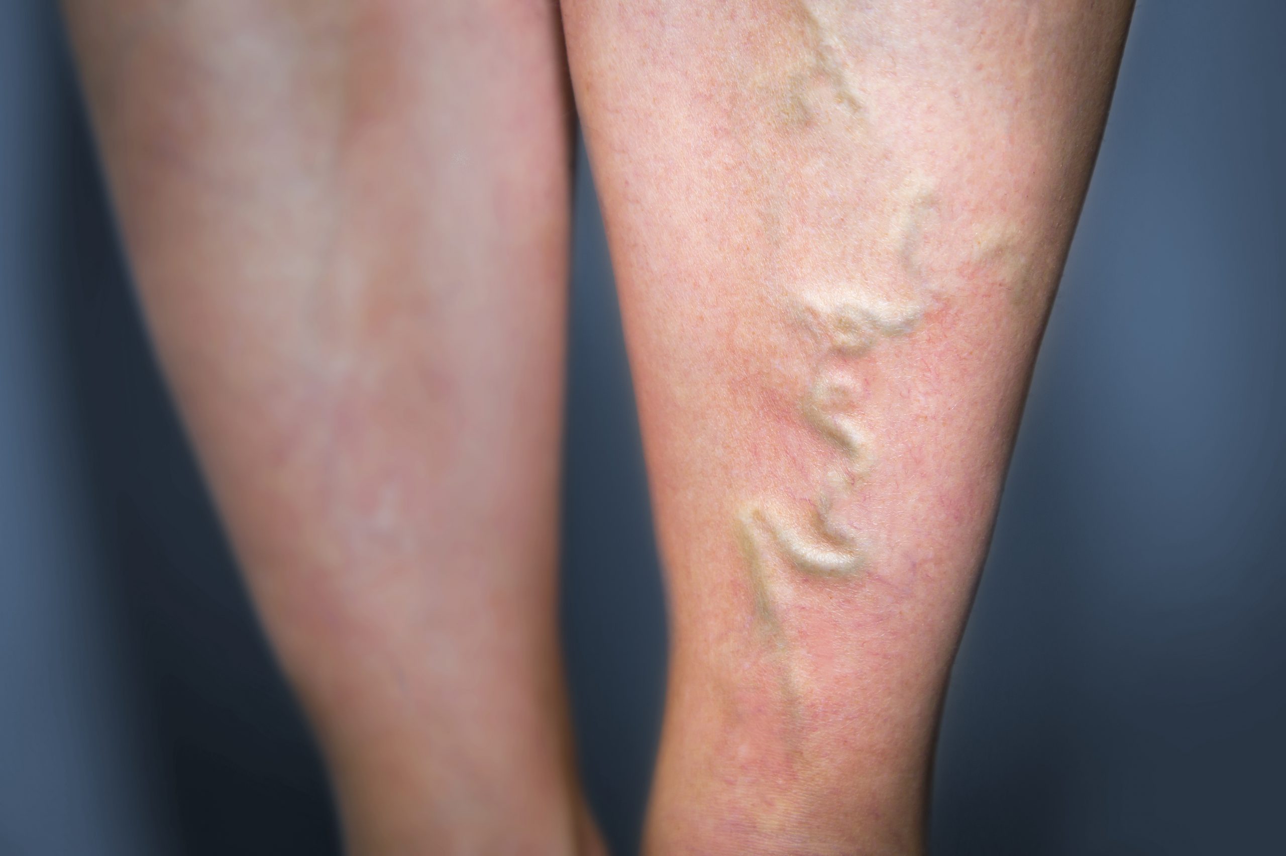 Leg Vein Treatment - Eliminate Spider & Varicose Veins - SKN