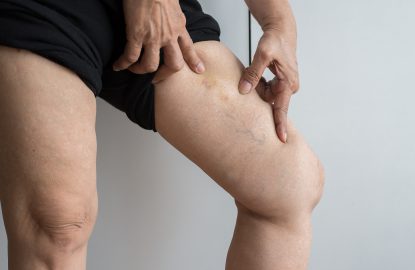 Varicose veins on the elderly asian woman leg,Close up